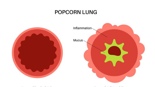 Popcorn lung is also a possibility. Picture: iStock