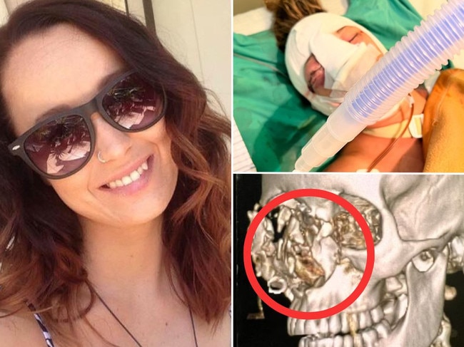 Rebecca Ode was involved in a mysterious accident while in Bali.