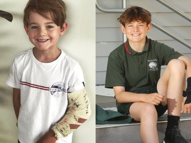 Freddie Price left school in an ambulance on his first day of prep. Now, seven years later, heâs finishing his time at Bellbrae Primary School the same way he started it â with a broken arm.