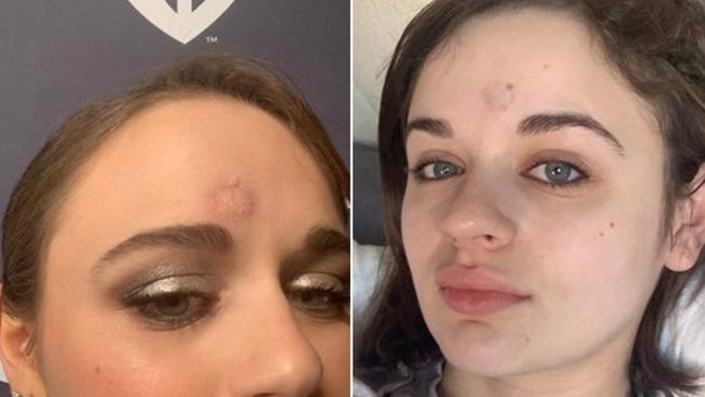 Joey King shows off her bruise from Patricia Arquette's Golden Globe trophy.