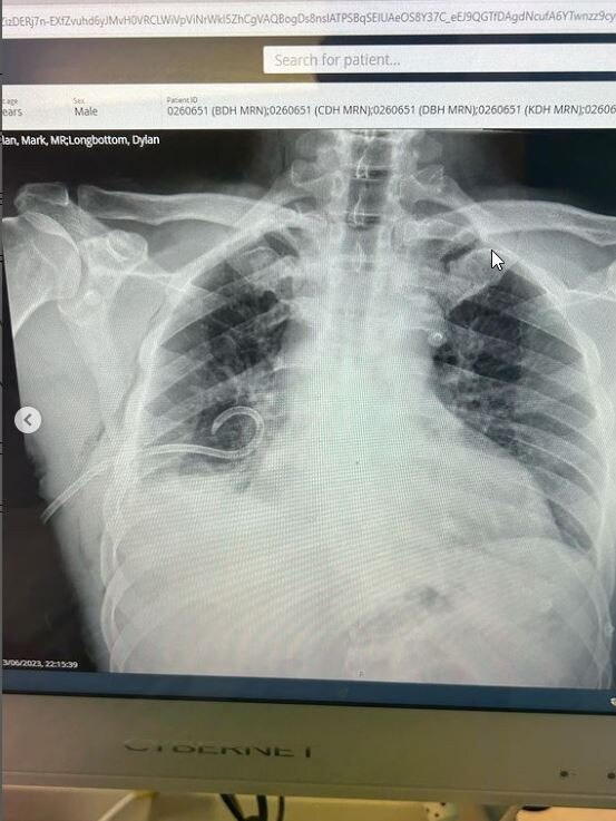 Dylan Longbottom’s X-rays showing a tube draining his lung. Pictures: Instagram/Dylan Longbottom