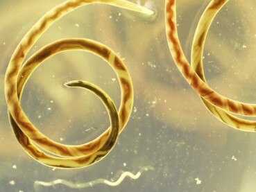 ‘Unusual’: Gruesome find in woman’s brain