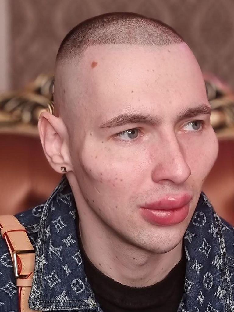 Ex-Russian soldier Kirill Tereshin, 25, embarked on cosmetic treatment to alter his face.