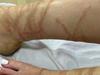 ‘I’m literally dying’: Girl lucky to be alive after jellyfish sting
