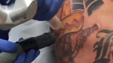 Toby Mitchell posted the tattoo removal process on Instagram. Picture: thetobymitchell/Instagram