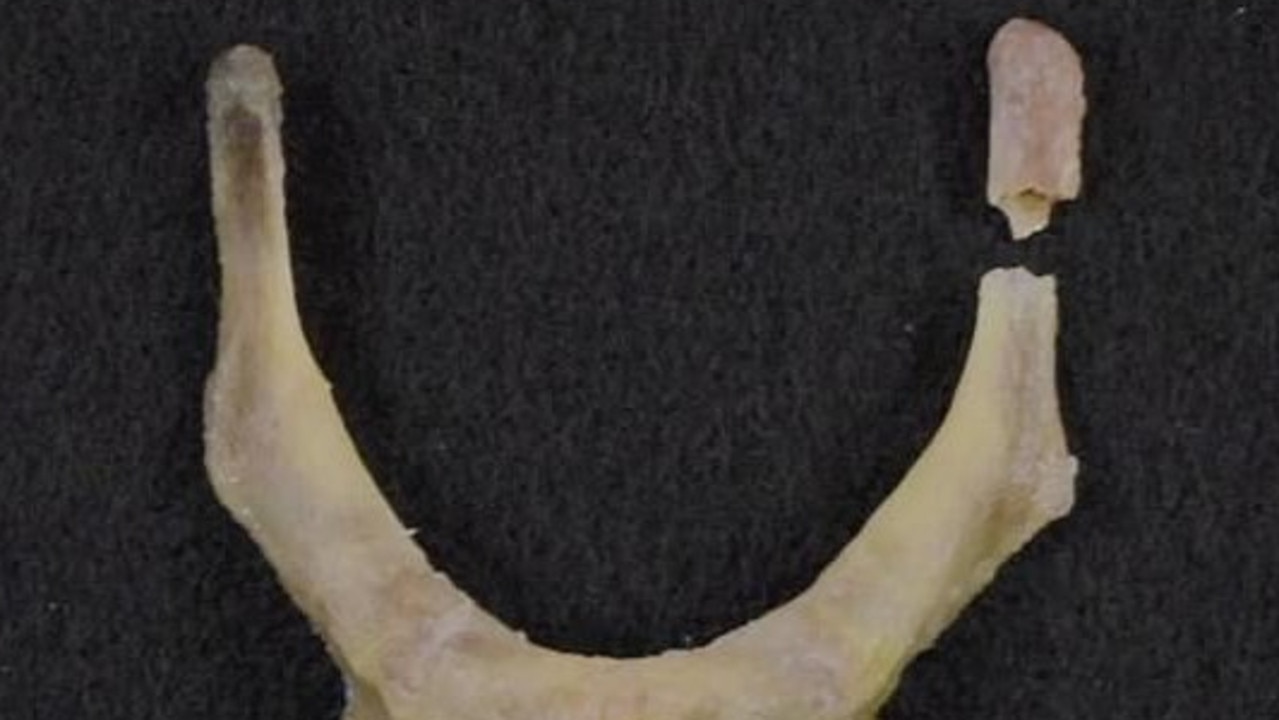 Epstein's broken hyoid bone. Picture: CBS/60 Minutes.