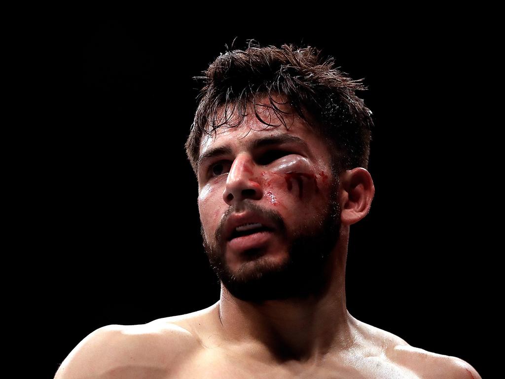 Yair Rodriguez sports a major bruise during a fight. Picture: Ronald Martinez/Getty Images/AFP.