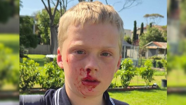 William , 10, after being attacked by a butcherbird on the Mornington Peninsula. Picture: supplied