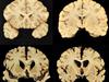 Grim Aussie-first uncovered in brain scan