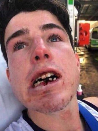 Fremantle rookie Andrew Brayshaw before he underwent surgery to repair a broken jaw and three ‘displaced’ lower teeth. Photo: Facebook/Freesupporterspage