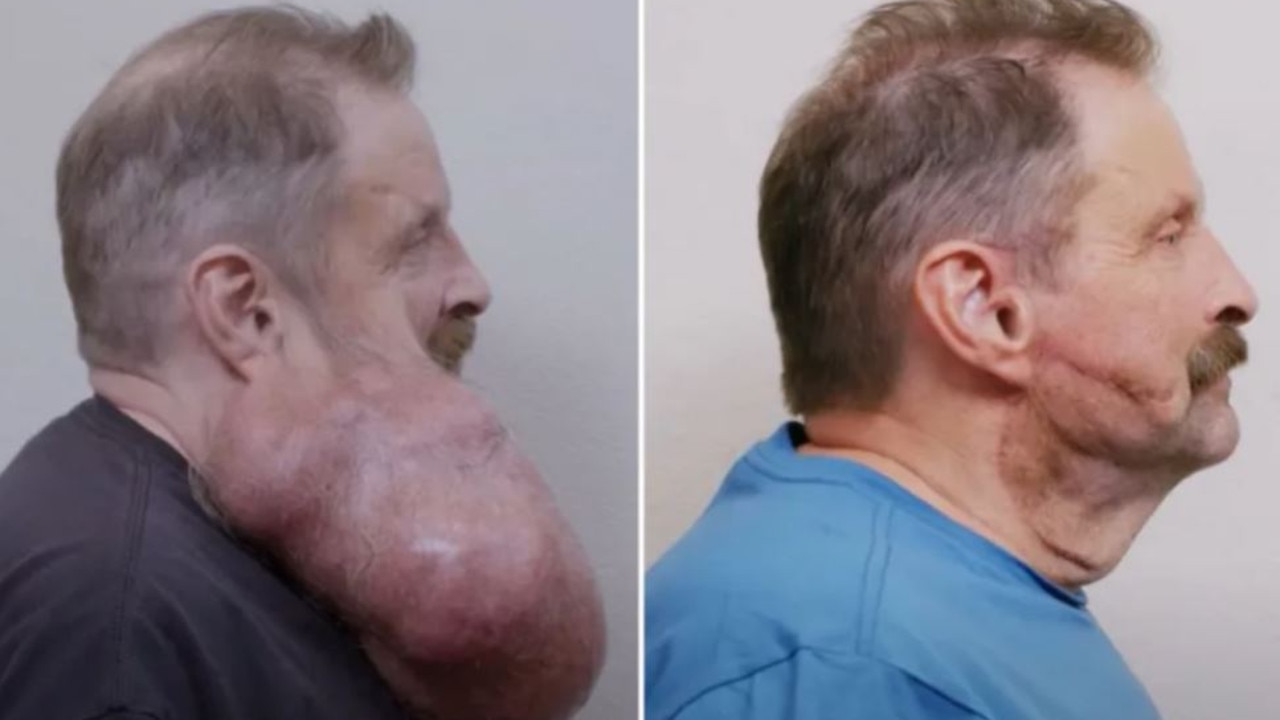 Tim underwent a challenging surgery to remove the growth and now feels "lighter". Picture: TLC/YouTube