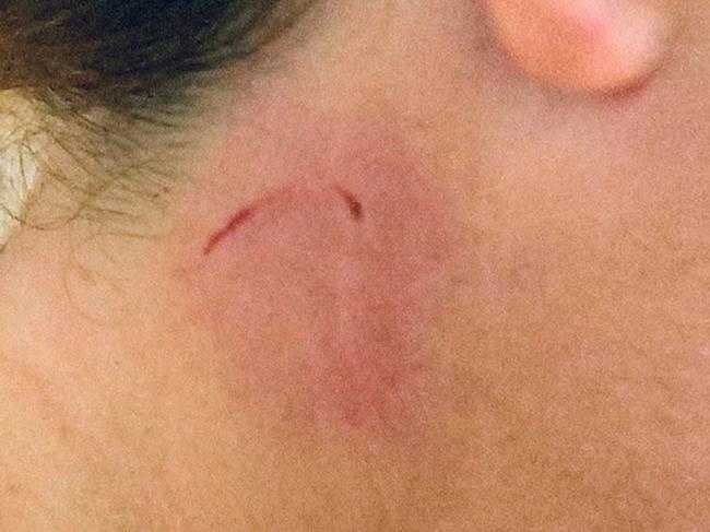 ONE TIME WEB USE ONLY - FEE APPLIES FOR REUSE -  PIC FROM The Photozigner Journey/caters News - (PICTURED:Patrizia Accoglienzas bite wound) - A traumatised tourist has issued a travel warning after she found herself over ,000 AUD out of pocket after claiming she was ATTACKED by a monkey that bit her neck while on holiday in Bali. With it being her first time visiting the Indonesian tourist island of Bali,Patrizia Accoglienzathought it would be fun to check out the popular Sacred Monkey Forest Sanctuary during her stay (19 JUNE).SEE CATERS COPY  Picture: Caters News Agency