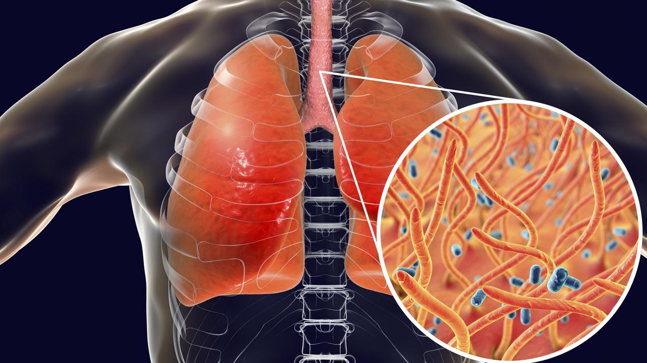 Whooping cough is a highly contagious infectious disease caused by Bordetella pertussis bacteria. The main symptoms are paroxysms of cough and inspiratory whoop, the bacteria are spread by coughing and by nasal drops. The incubation period is 7-14 days. Treatment is with antibiotics. A vaccine is available for this bacterial pathogen.