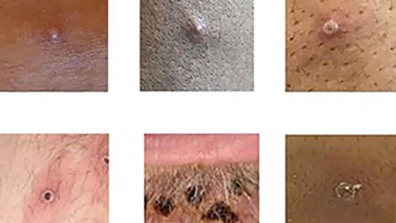 A handout made available by the UK Health Security Agency (UKHSA) on a variety of monkeypox rash lesions. Picture: Handout / UK Health Security Agency / AFP.