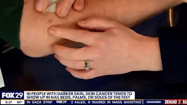 Dr Joanna Walker told Merrick that he has “very slow-growing type of skin cancer” on his arm.