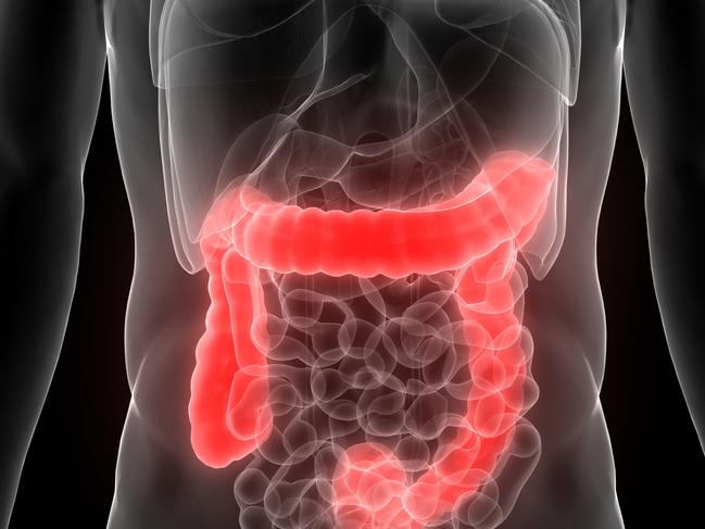 BOWEL CANCER: Did you know it's treatable and beatable if detected early?