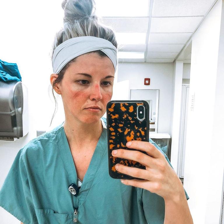 US nurse Syndi Lane showing the marks on face from wearing PPE. Picture: Instagram