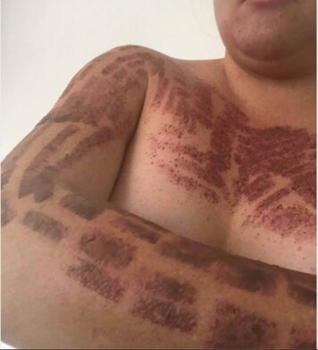 An example of burns caused by laser due to an inexperienced practitioner supplied by the Aesthetics Practitioners Advisory Network.