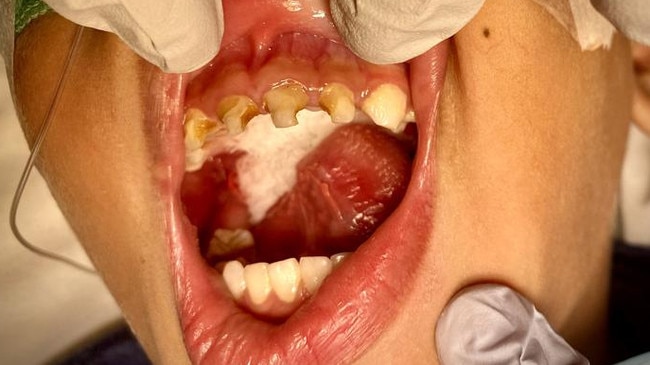 An unidentified young oral health patient from Far North Queensland who recently required surgery due to tooth decay. Picture: Supplied