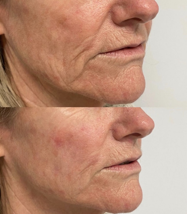 Biostimulant filler to tighten and give a lifted appearance to the lower face at About Face.