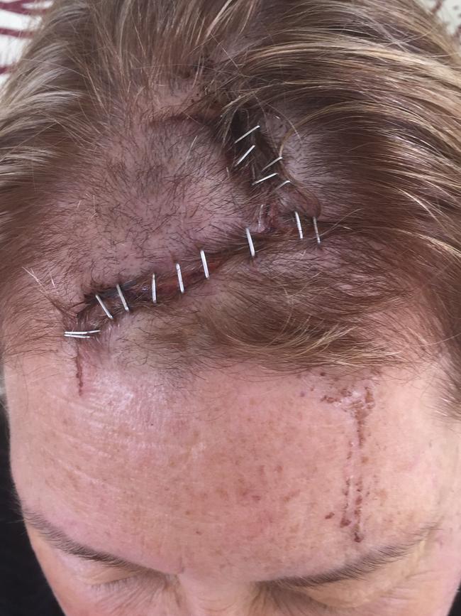 Linda Shannon suffered a serious head wound. Picture: Supplied