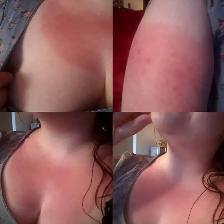 Sunburn Snow Breasts