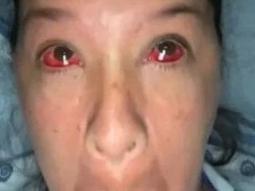 A woman has left people stunned after revealing she burst every blood vessel in her face when giving birth. Picture: TikTok