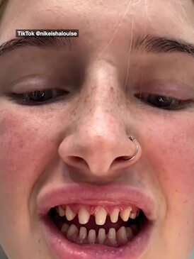 Woman warns against popular teeth trend