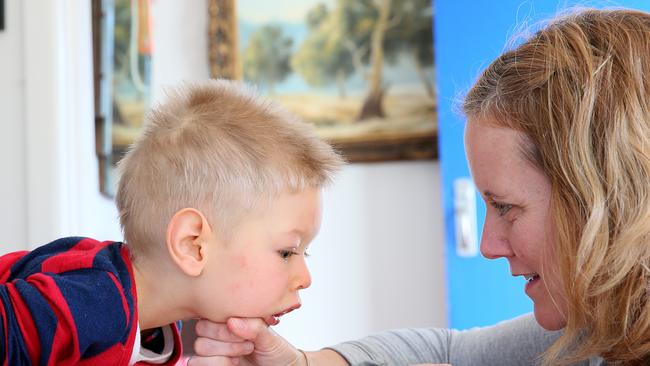 Ina Mills gives her son Roki, 3, physical therapy at their Newport home. Picture: Troy Snook