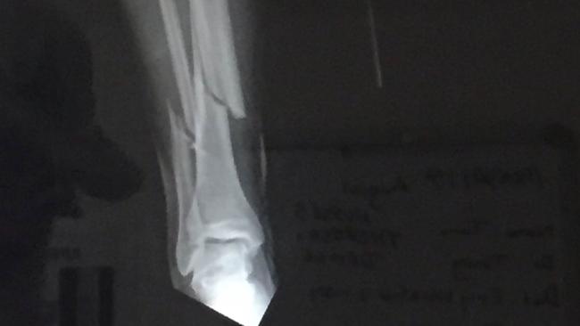 An X-ray showing the double break in Tom Rowles’ right leg.