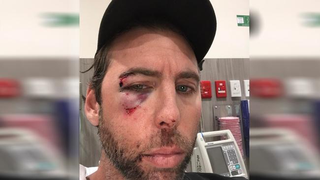 Grant Hackett posted a photo online of facial injuries allegedly inflicted in an incident involving his brother. Picture: Instagram