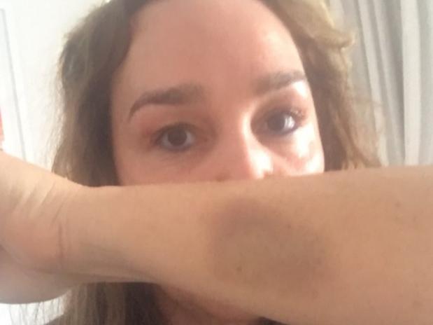 Kate Langbroek with bruise she sustained after she was attacked in her St Kilda home on March 2. Twitter: @MartinFoleyMP Thanks for your call yesterday. This is the bruise I sustained trying to keep that “vulnerable” resident from kicking our front door in on Friday night. Children inside. The real vulnerable are the decent citizens of St Kilda. We await your action.