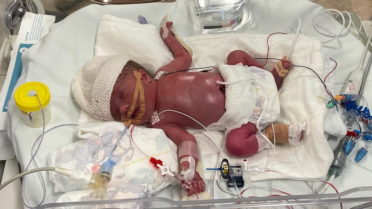 Little Tilly soon after she was delivered. The baby had to undergo surgery. Picture supplied