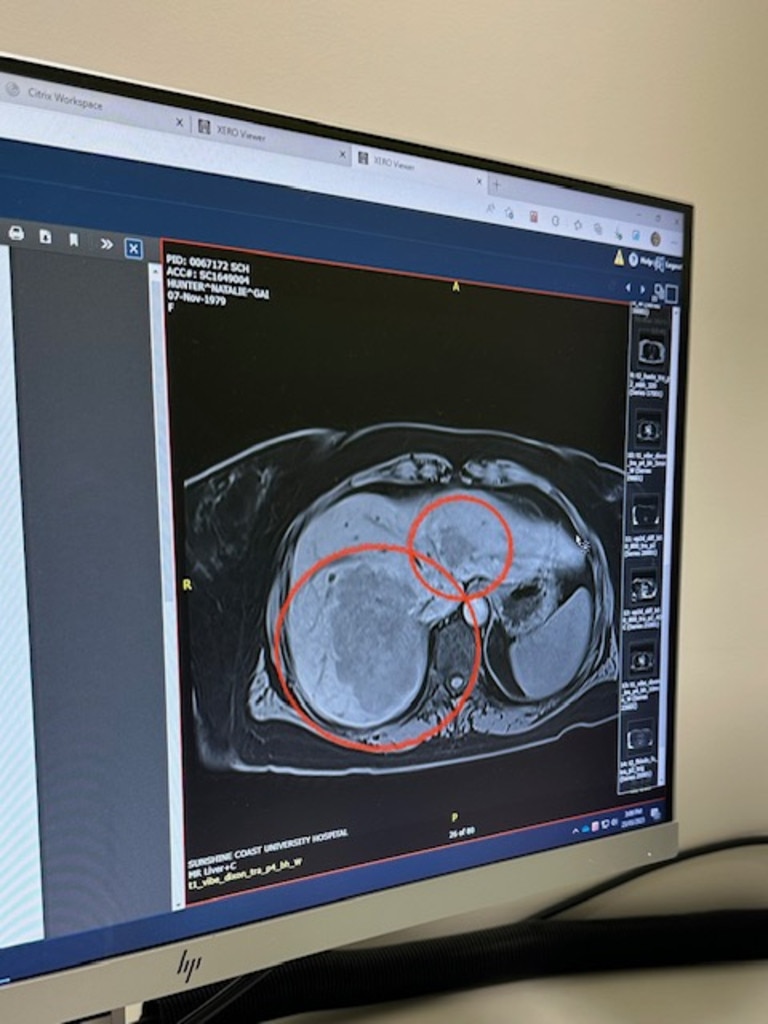 One of the tumours was the size of her palm. Picture: Supplied