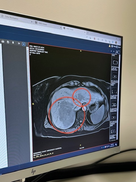 One of the tumours was the size of her palm. Picture: Supplied