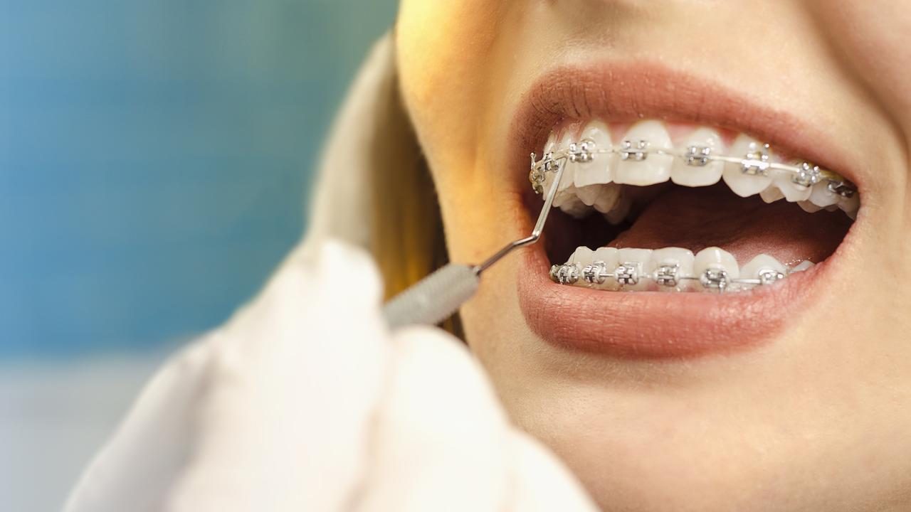 Private health insurance may cover some of the cost of orthodontics like braces and aligners if you have an extras policy.