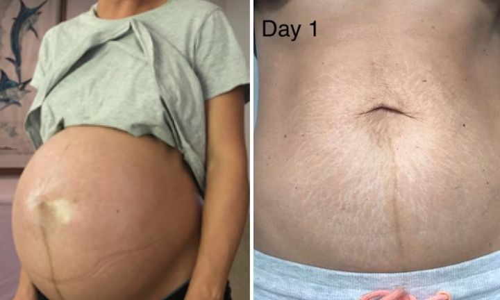 stretch marks after twin pregnancy