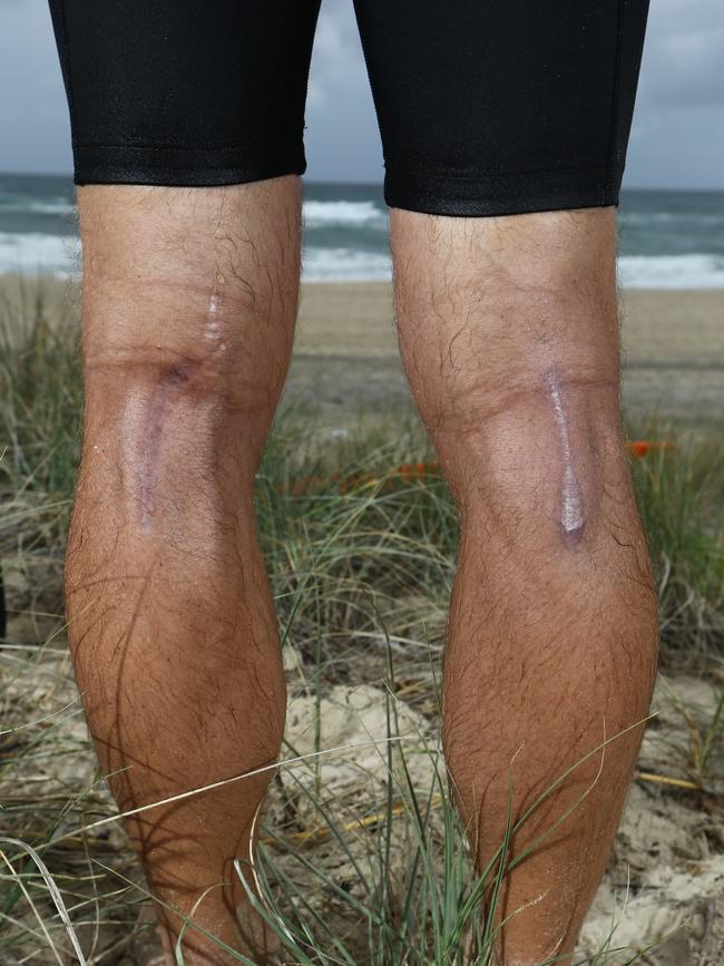 Shannon Eckstein has had surgery before on his troublesome calves. Picture Glenn Hampson