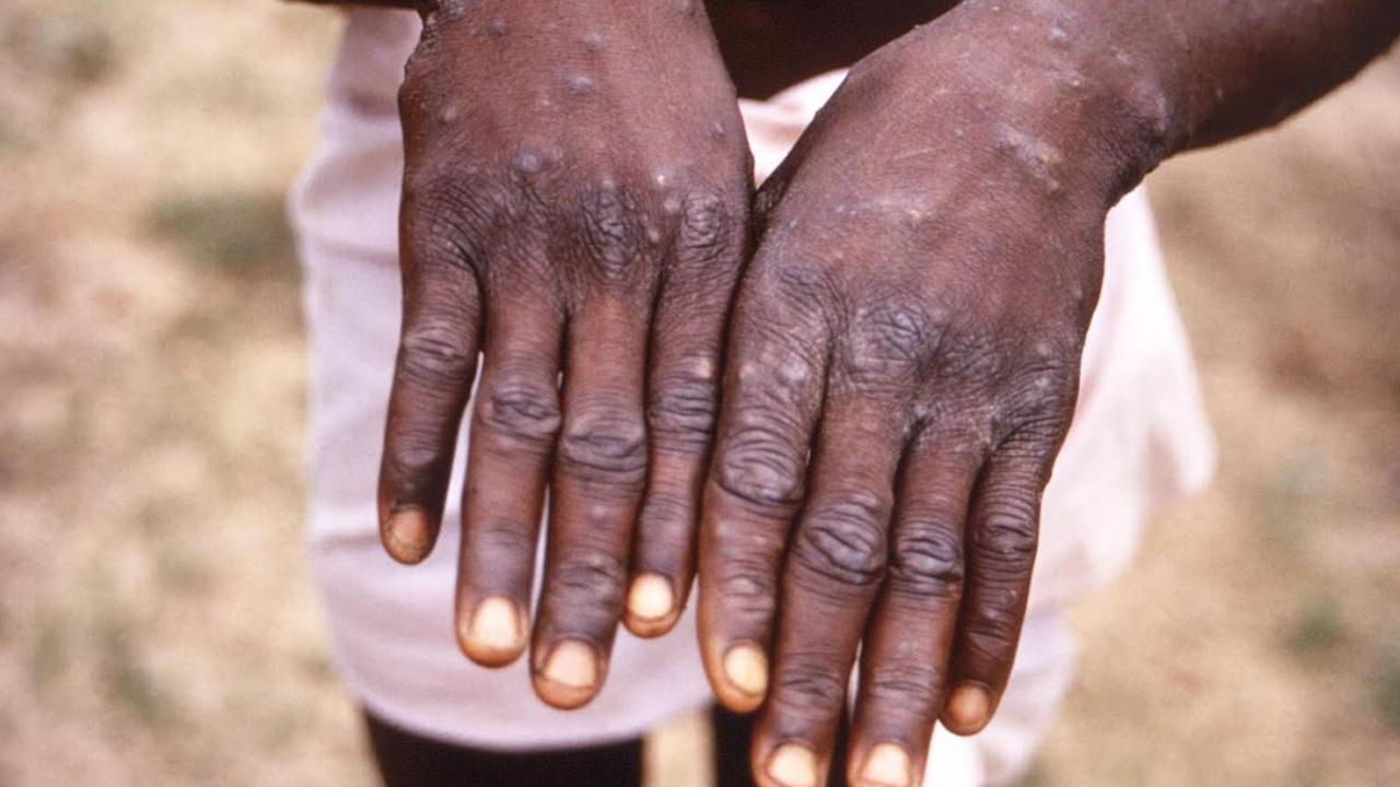 Monkeypox can cause lesions across the body. Picture: Smith Collection/Gado/Getty Images
