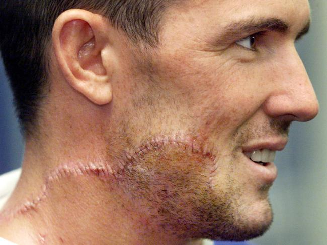 Stevens nearly died in 1999 after broken glass cut his neck and face.