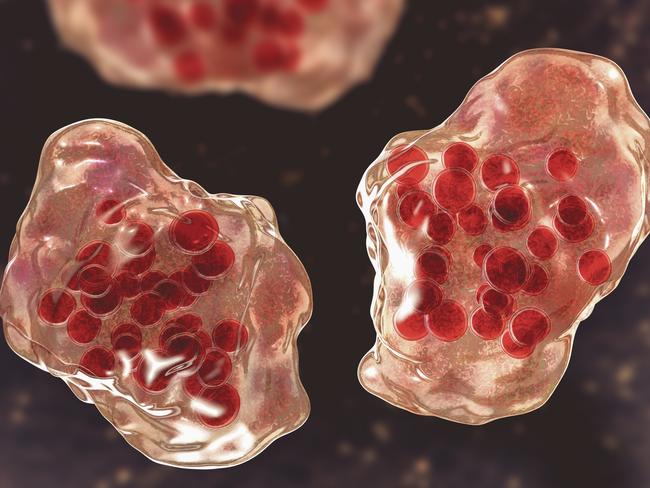 Illustration of measles virus infection showing giant multinucleated cells seen during microscopy of biopsy specimens, known as Warthin-Finkeldey giant cells.