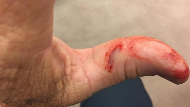 Brian Burston’s thumb following the incident. Picture: Supplied