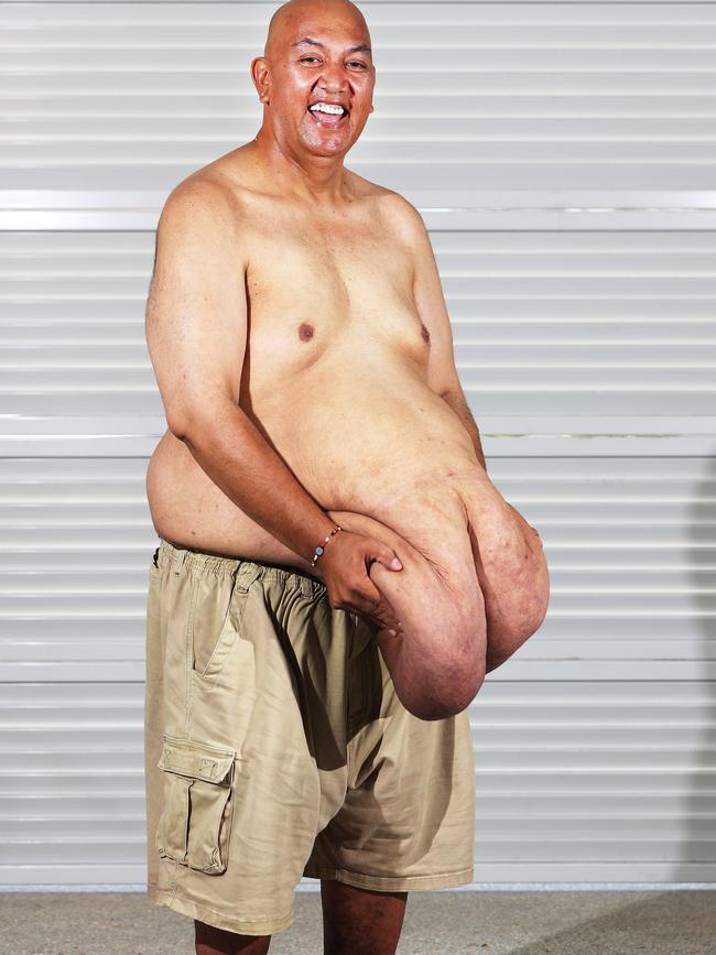 Thomas Teneti has lost a huge amount of weight and is raising funds to remove his excess skin. Picture Glenn Hampson