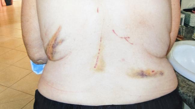 Suzanne Gransden was attacked in September and December 2021 by wallabies at Carlyle Gardens in Condon.