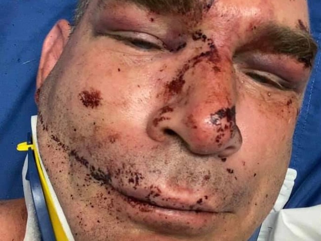 Ben Woolley’s injuries he suffered during a bashing at Ron Andrews Park in Pakenham.