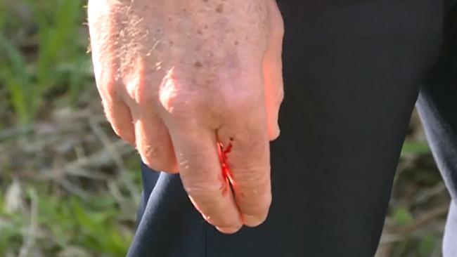 Mr Whitby's finger could be seen later in the media conference starting to bleed from the possum bite. Picture: Seven News.