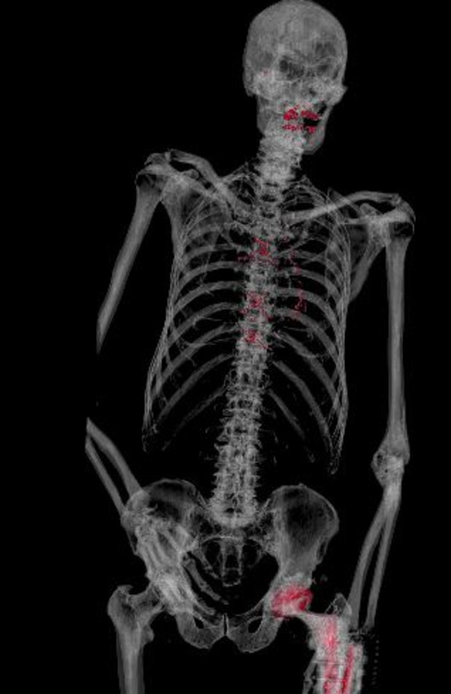 CT scans of corpses are helping forensic investigations. Picture: Supplied