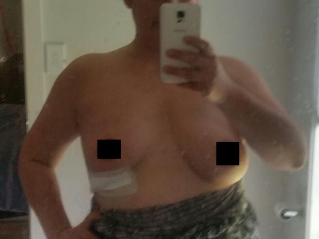 Samantha after the removal of her right breast.