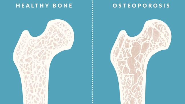 Timothy Dreyer could help counter osteoporosis and return bones to a healthy level.