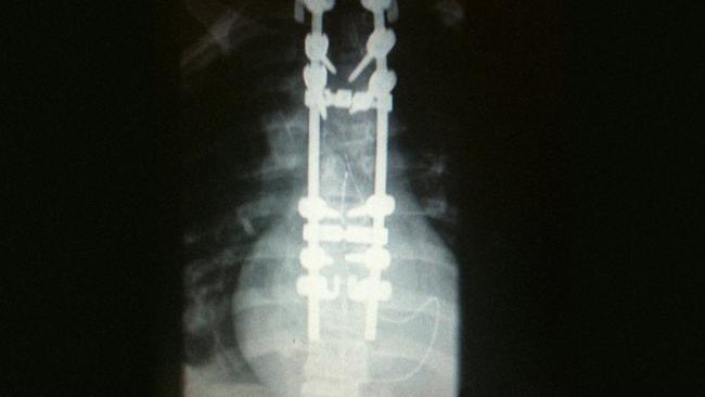 The X-ray showing the damage suffered to Ms Haydon's spine following her accident. Picture: Supplied.